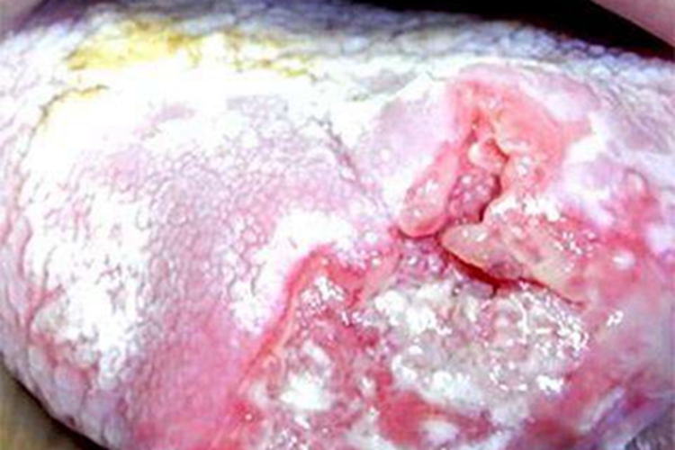 舌癌舌头裂纹图