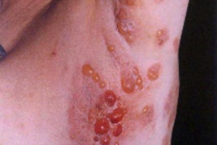 疱疹样皮炎腋窝症状图 疱疹样皮炎腋窝症状图