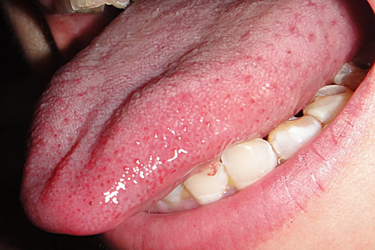 正常人舌乳头图 正常人舌乳头图