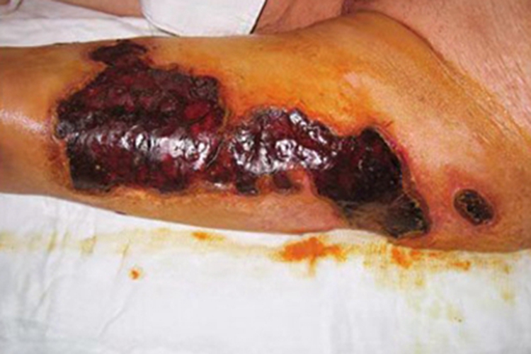 坏死性筋膜炎皮肤发黑图