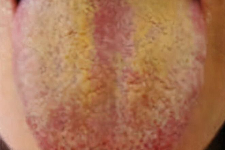 深黄苔图 深黄苔图