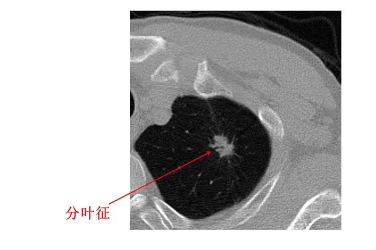 恶性肺结节分叶征图