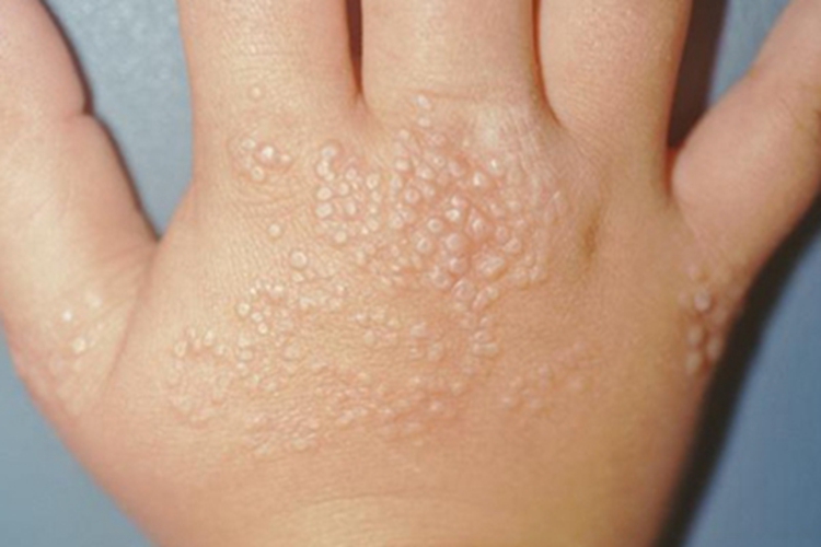 光泽苔藓手背症状图