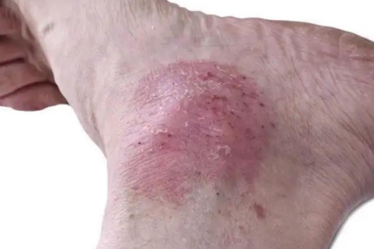 银屑病脚踝症状图 银屑病脚踝症状图