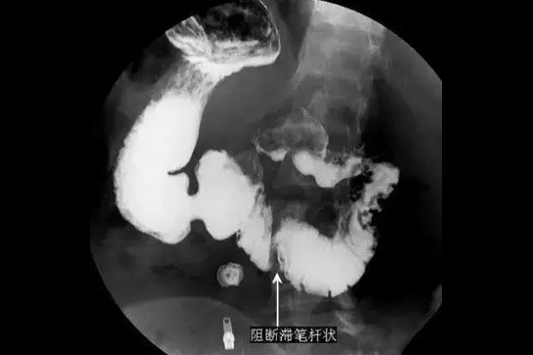 十二指肠溃疡造影图 十二指肠溃疡造影图