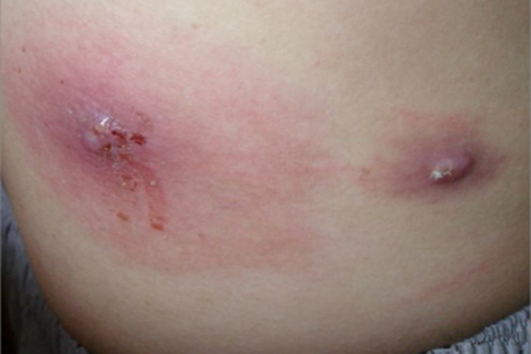 皮肤阿米巴病腹部症状图