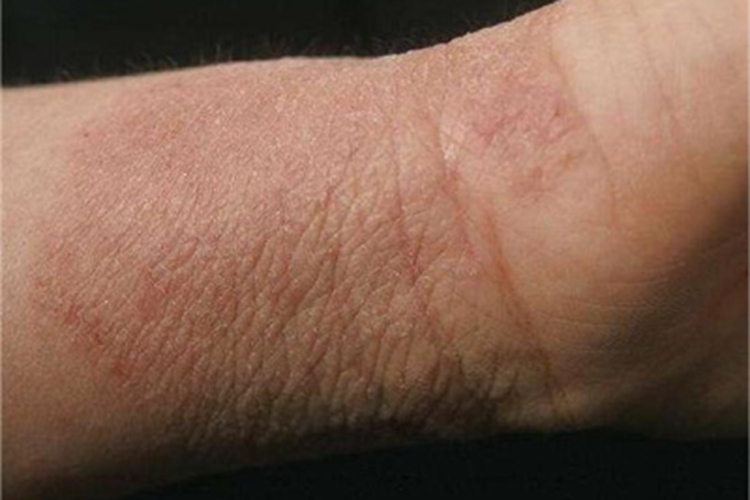 扁平苔藓样接触性皮炎手腕症状图 扁平苔藓样接触性皮炎手腕症状图