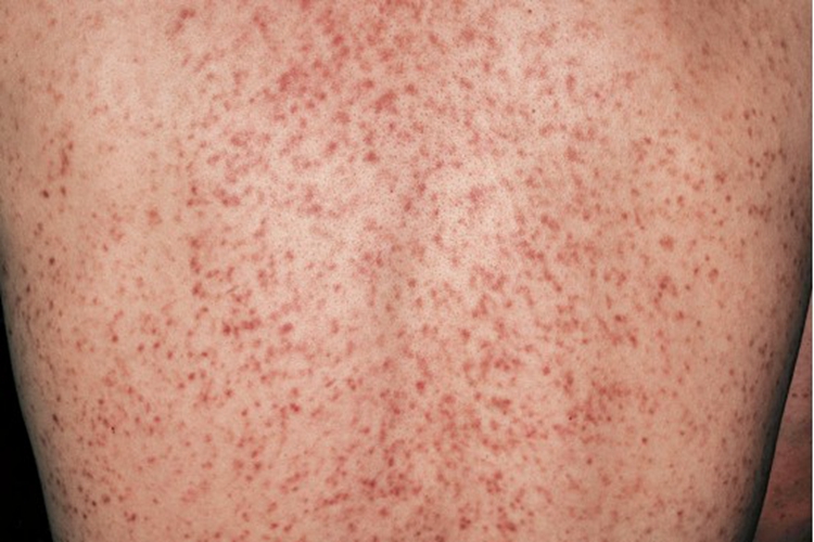 慢性苔藓样糠疹背部丘疹图