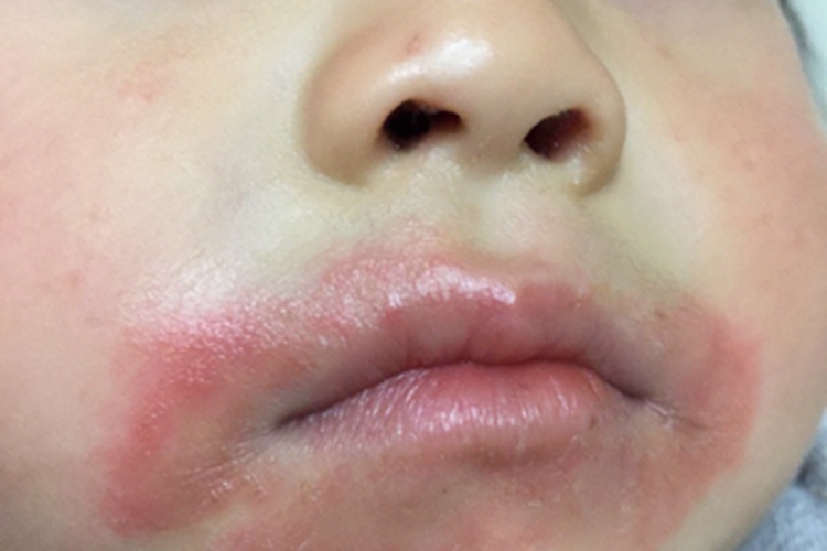 婴儿期特应性皮炎口周长大红斑图 婴儿期特应性皮炎口周长大红斑图