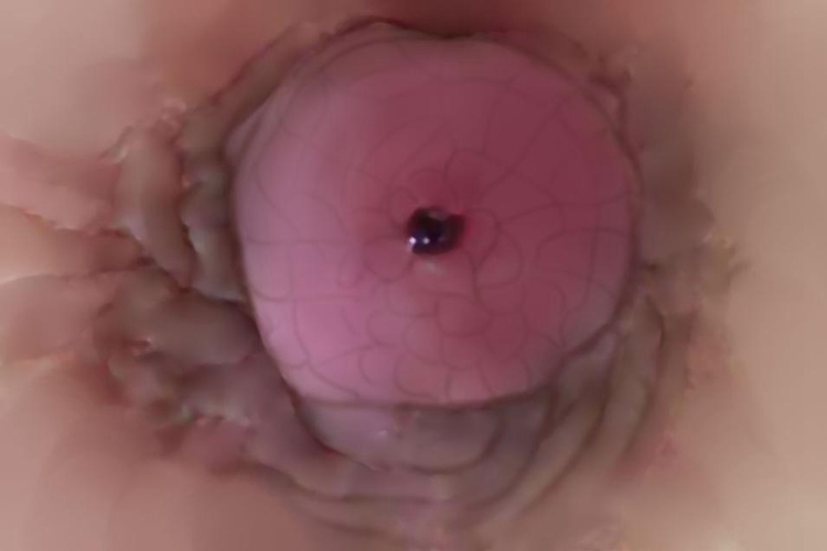 血性乳头溢液图 血性乳头溢液图