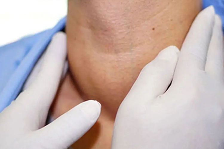 单纯性甲状腺肿前颈肿图 单纯性甲状腺肿前颈肿图