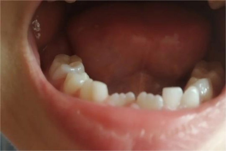 门牙边缘锯齿状图 门牙边缘锯齿状图