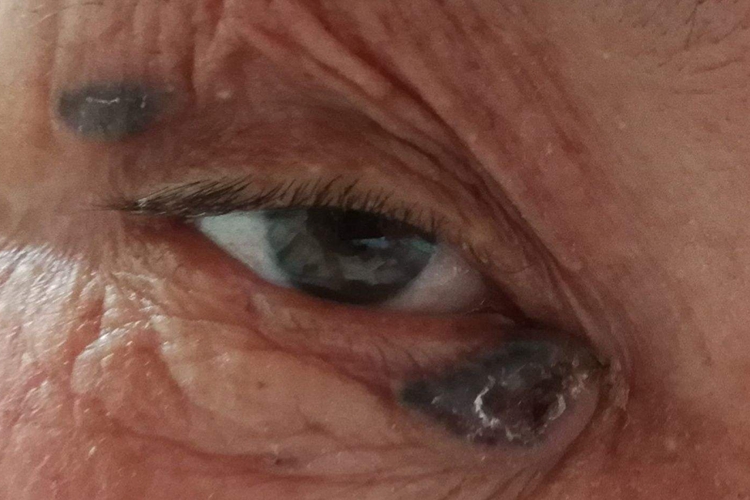 右眼眼睑基底细胞癌图