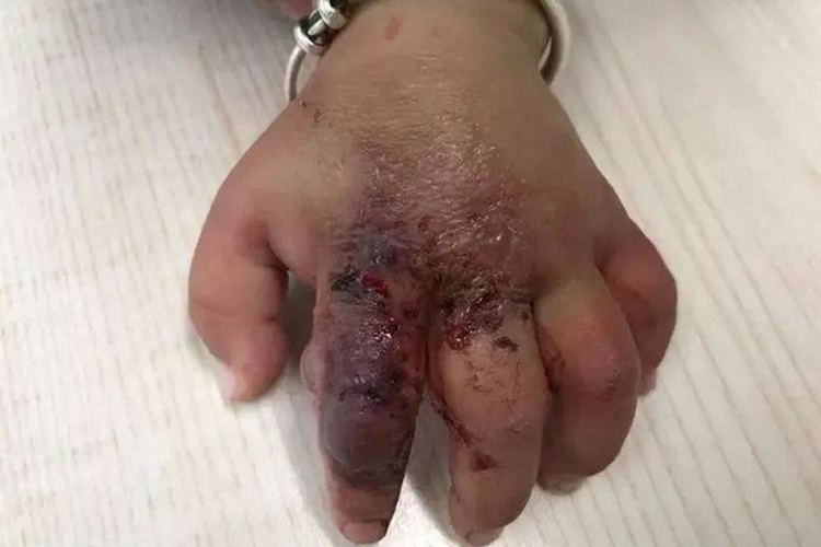虫咬皮炎手指溃疡图