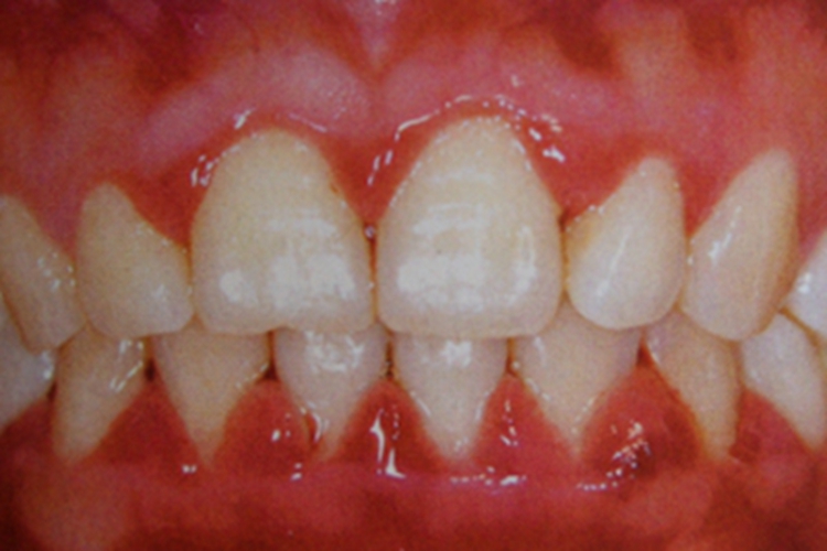 妊娠期龈炎症状图