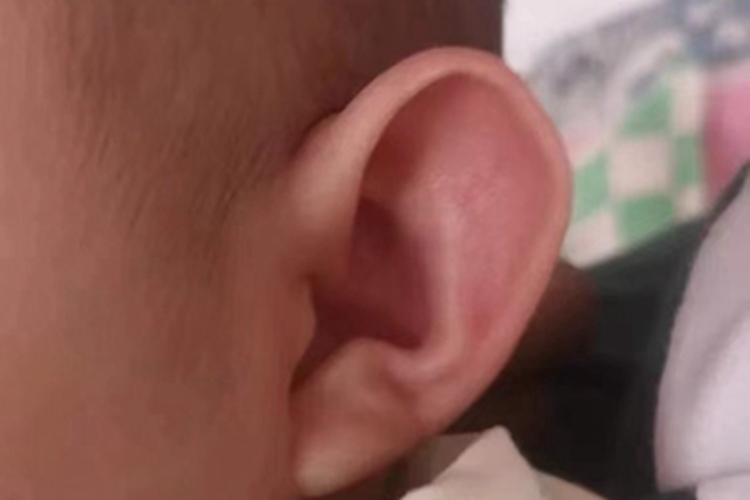 招风耳耳廓上面平坦图