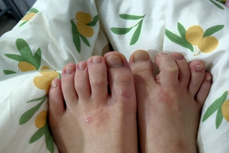 慢性湿疹脚背红斑图 慢性湿疹脚背红斑图