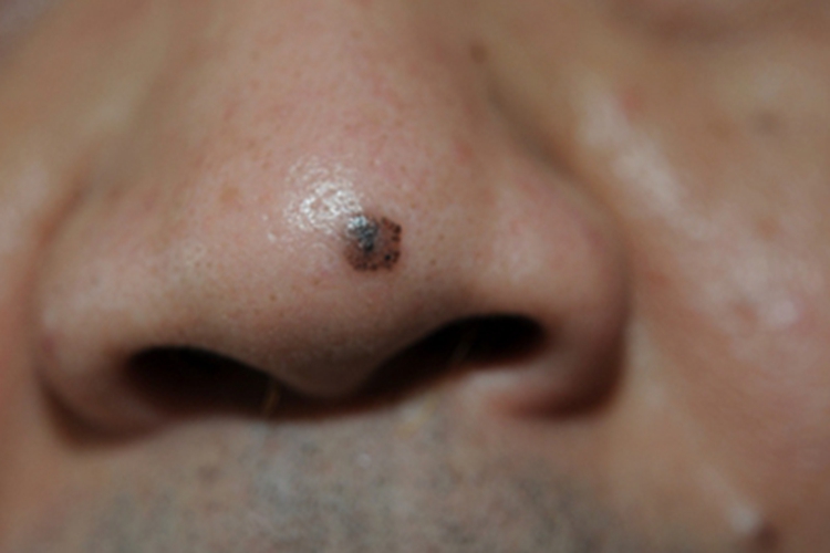 表浅型基底细胞瘤鼻尖有褐斑图