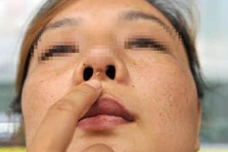 鼻小柱皮肤破溃图