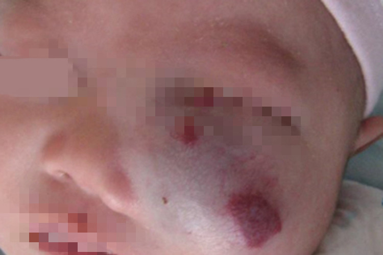 混合型婴儿血管瘤面部症状图