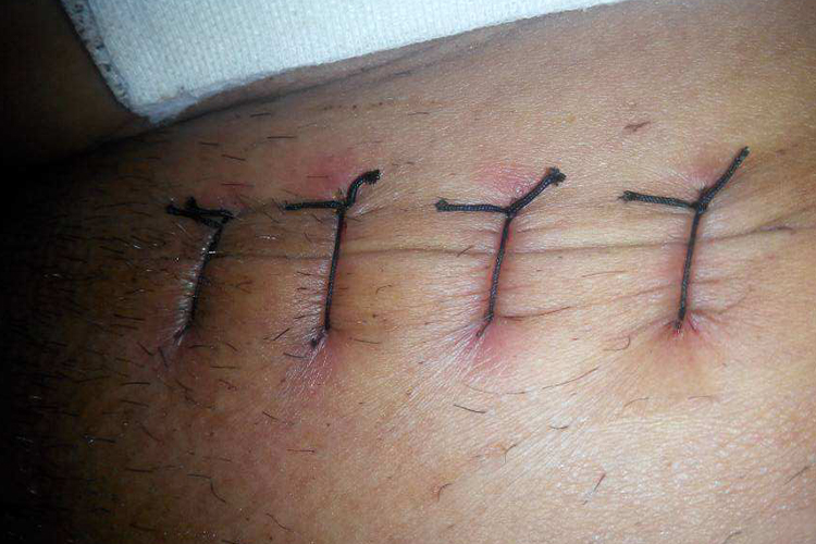 伤口可以拆线的标准图