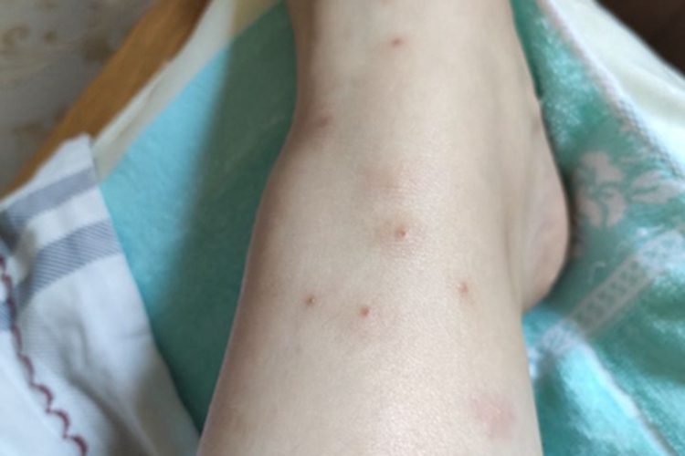 跳蚤叮咬脚踝结痂图