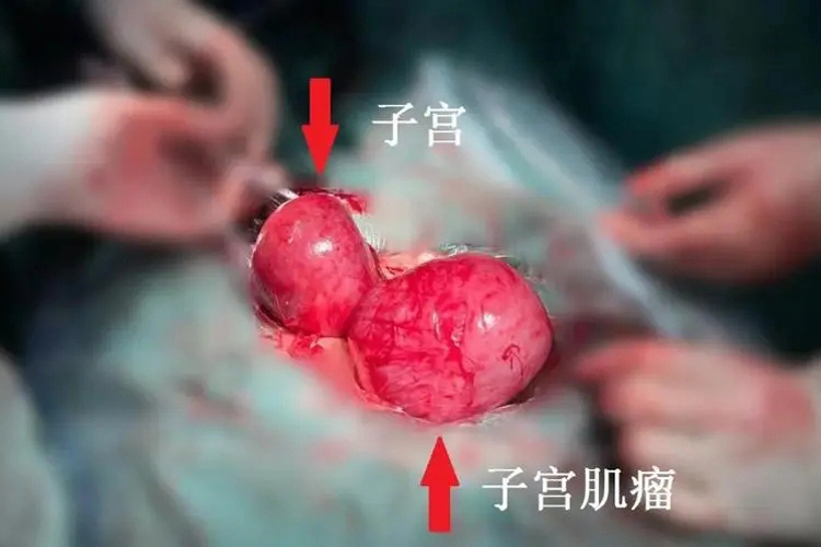 直径13公分的子宫肌瘤图
