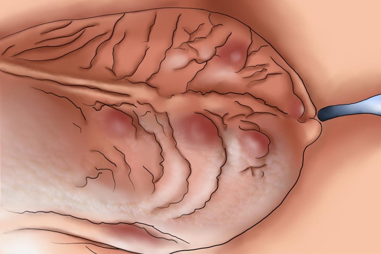 阴囊毛囊炎紫疙瘩图 阴囊毛囊炎紫疙瘩图