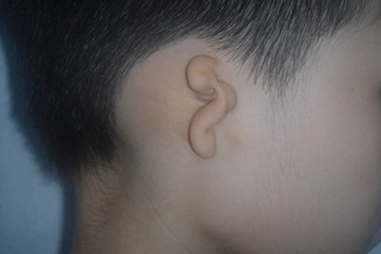 5P-综合征畸形图