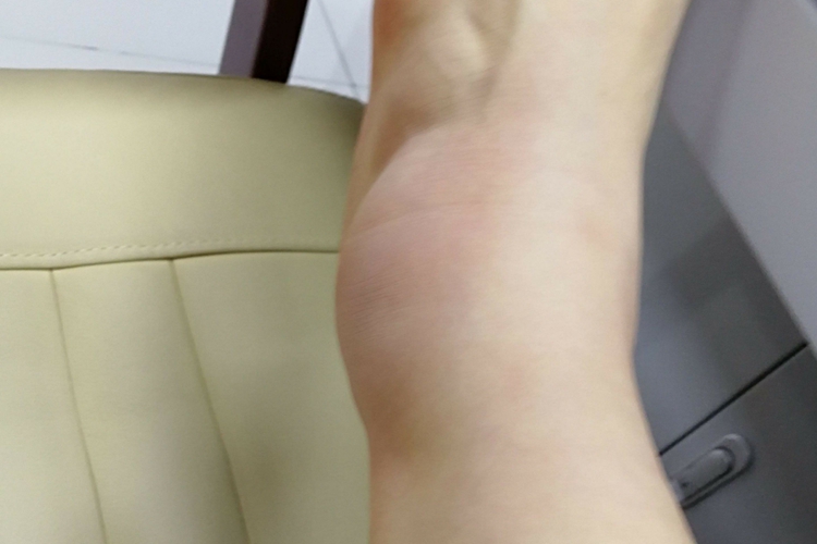 女性崴脚左脚肿胀图
