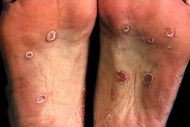 结节性梅毒疹脚底症状图 结节性梅毒疹脚底症状图