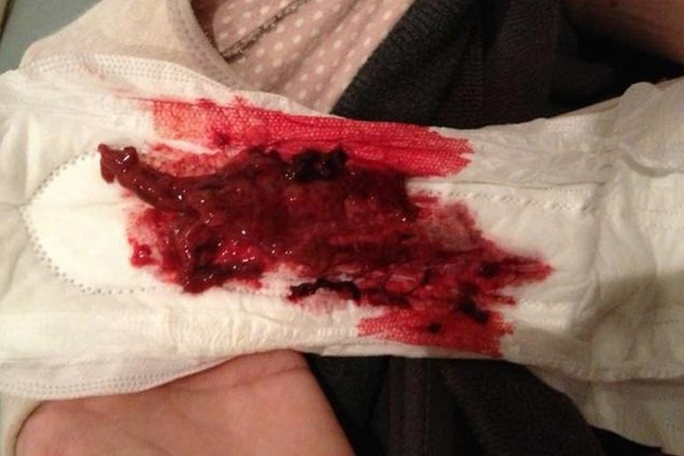 血性恶露颜色鲜红图