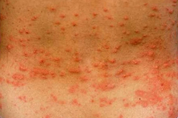 恙螨皮炎腰部小红疙瘩图 恙螨皮炎腰部小红疙瘩图