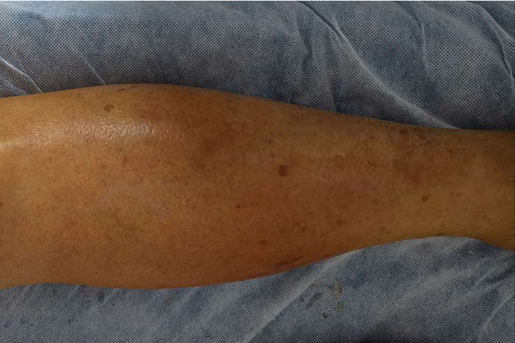 下肢深静脉血栓形成小腿红肿图 下肢深静脉血栓形成小腿红肿图