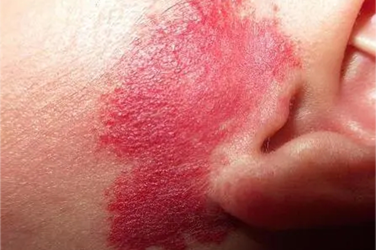 色素型胎记红斑图