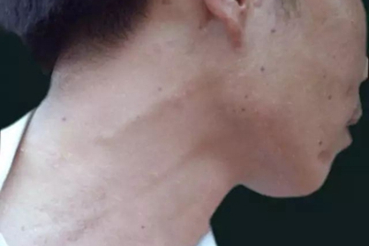 麻风病皮肤凹凸不平图 麻风病皮肤凹凸不平图