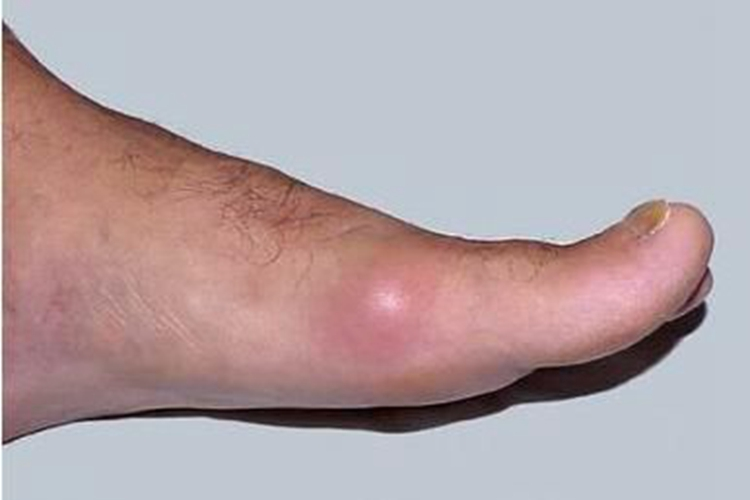 痛风初期关节红肿图