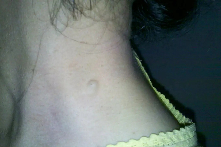 孩子脖子上长脂肪瘤图