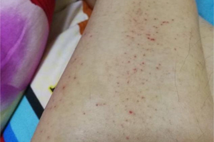 机械性紫癜小腿红点点图