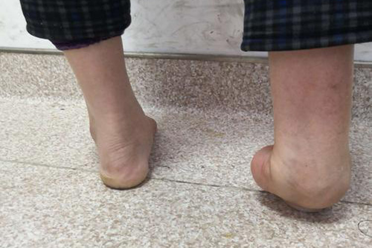 松软型足内翻图