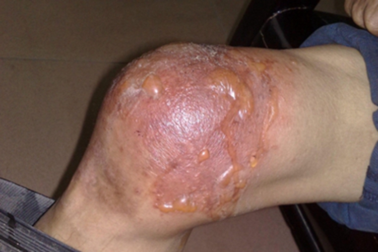 钩蚴性皮炎大水疱图 钩蚴性皮炎大水疱图