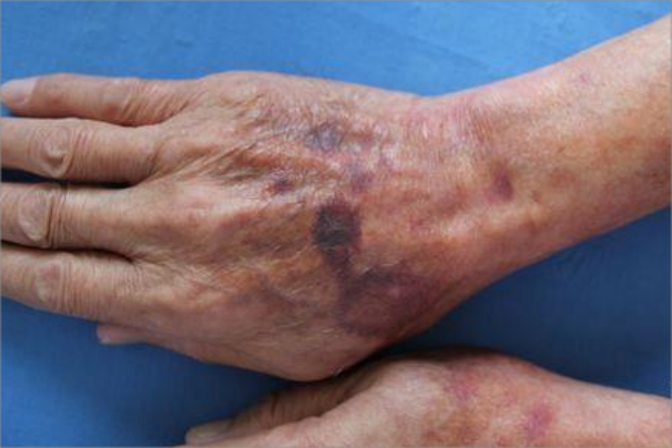 老年性紫癜手背症状图