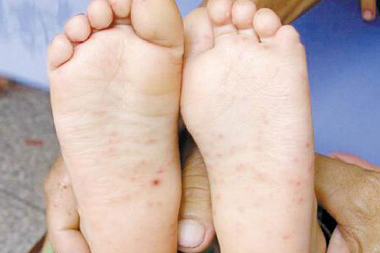 手足口病初期足部斑疹图