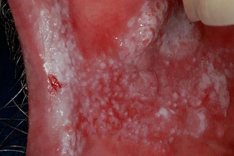 均质型口腔黏膜白斑斑块型白点图