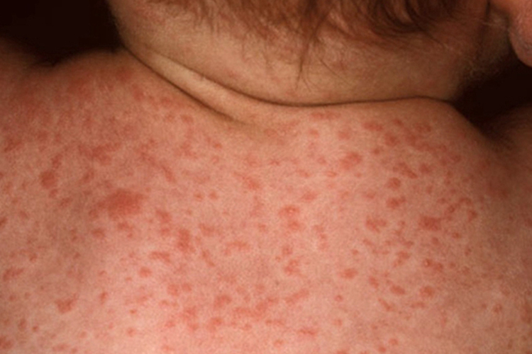 猩红热型药疹图 猩红热型药疹图