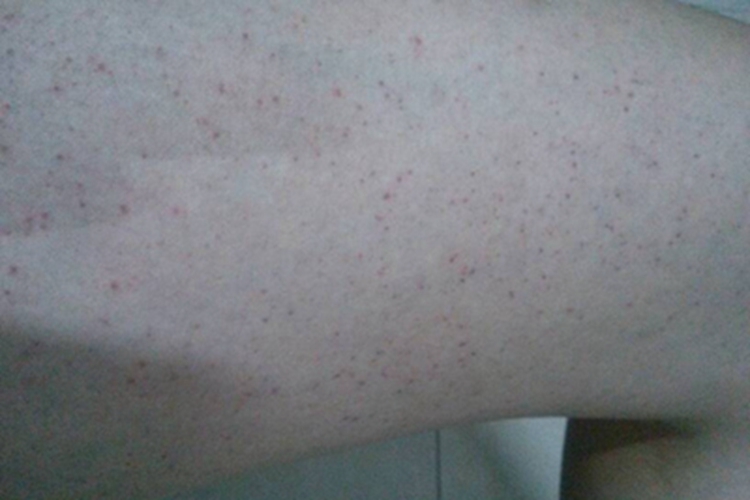 苯中毒大腿红点图