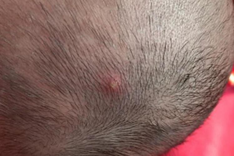 毛囊炎头皮疙瘩化脓图 毛囊炎头皮疙瘩化脓图