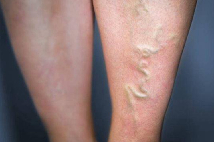 游走性血栓性静脉炎症状图