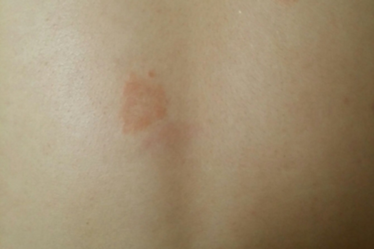 可变性红斑角化症背部症状图