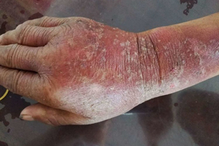 植物光皮炎手背脱皮图 植物光皮炎手背脱皮图
